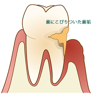 なかがわ歯科医院の歯周病を説明した画像